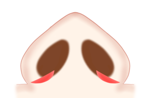 小鼻縮小 内側法