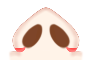 小鼻縮小 外側法