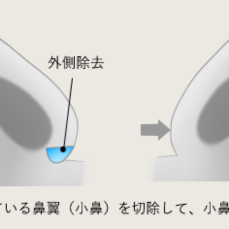 鼻尖形成MAX | 東京 大阪の美容整形なら、グローバル