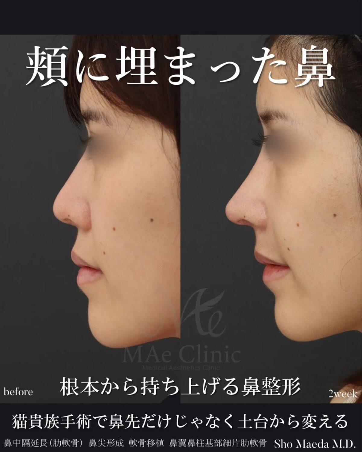 外鼻形成術・鼻中隔矯正術