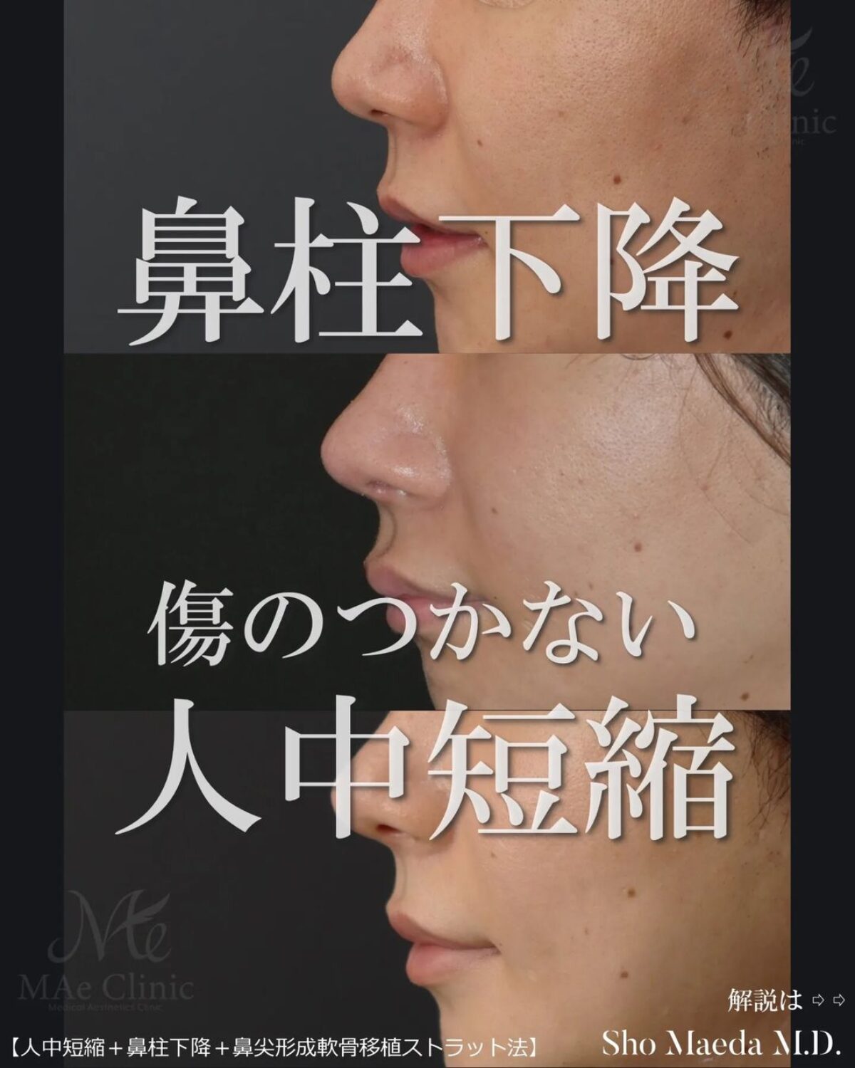 外鼻の再建 【裁断済み】 裁断済み） 外鼻の再建 外鼻の再建 | 小林誠一郎 |本 |