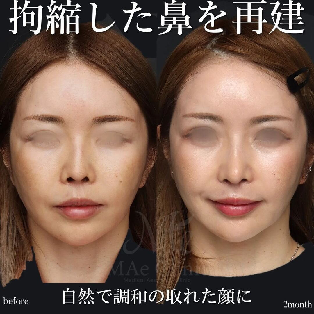 【裁断済】外鼻形成術・鼻中隔矯正術 外鼻形成術・鼻中隔矯正術 | 増山敬祐, 上條 篤, 増山敬祐, 上條