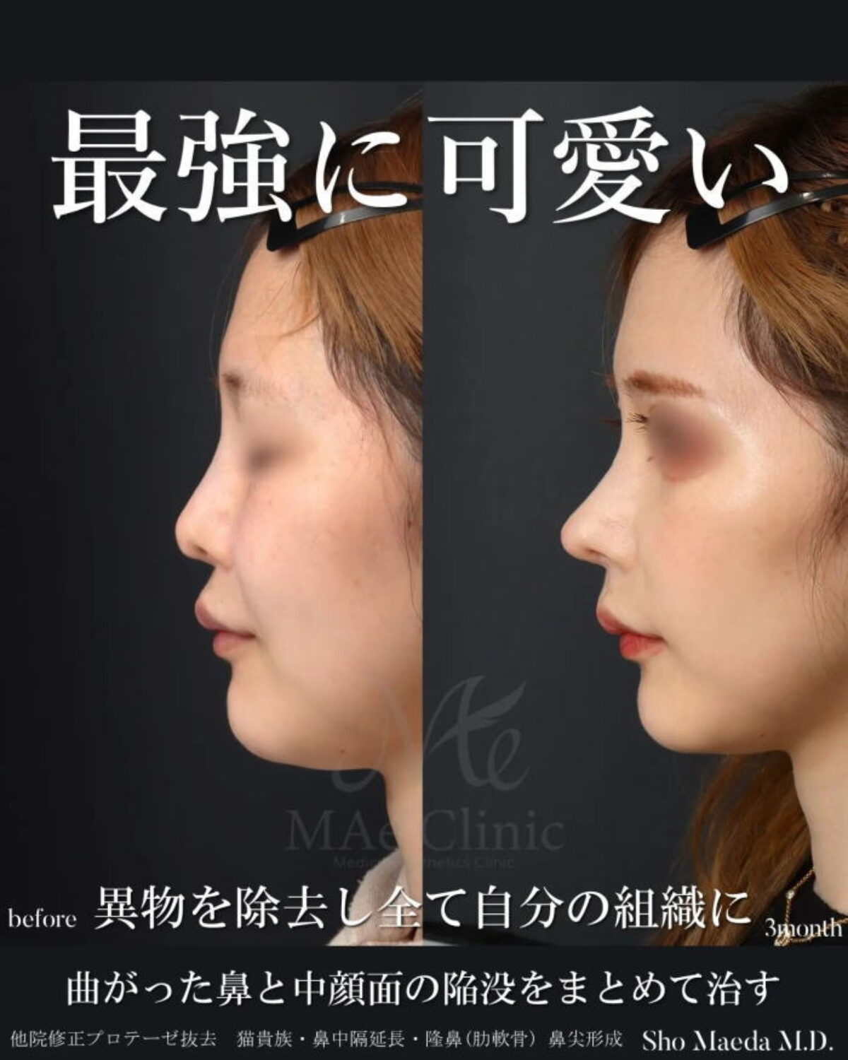 圧倒的に可愛くなる【他院修正（オステオポール、シリコン