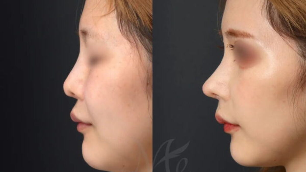 圧倒的に可愛くなる【他院修正（オステオポール、シリコン、メッシュ