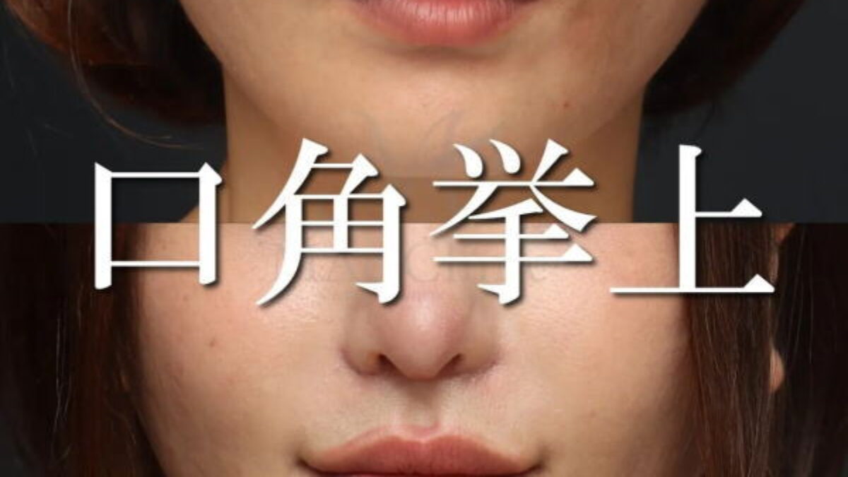 真顔も笑顔も可愛くなる【口角挙上】 | MAe Clinic【マエクリ】