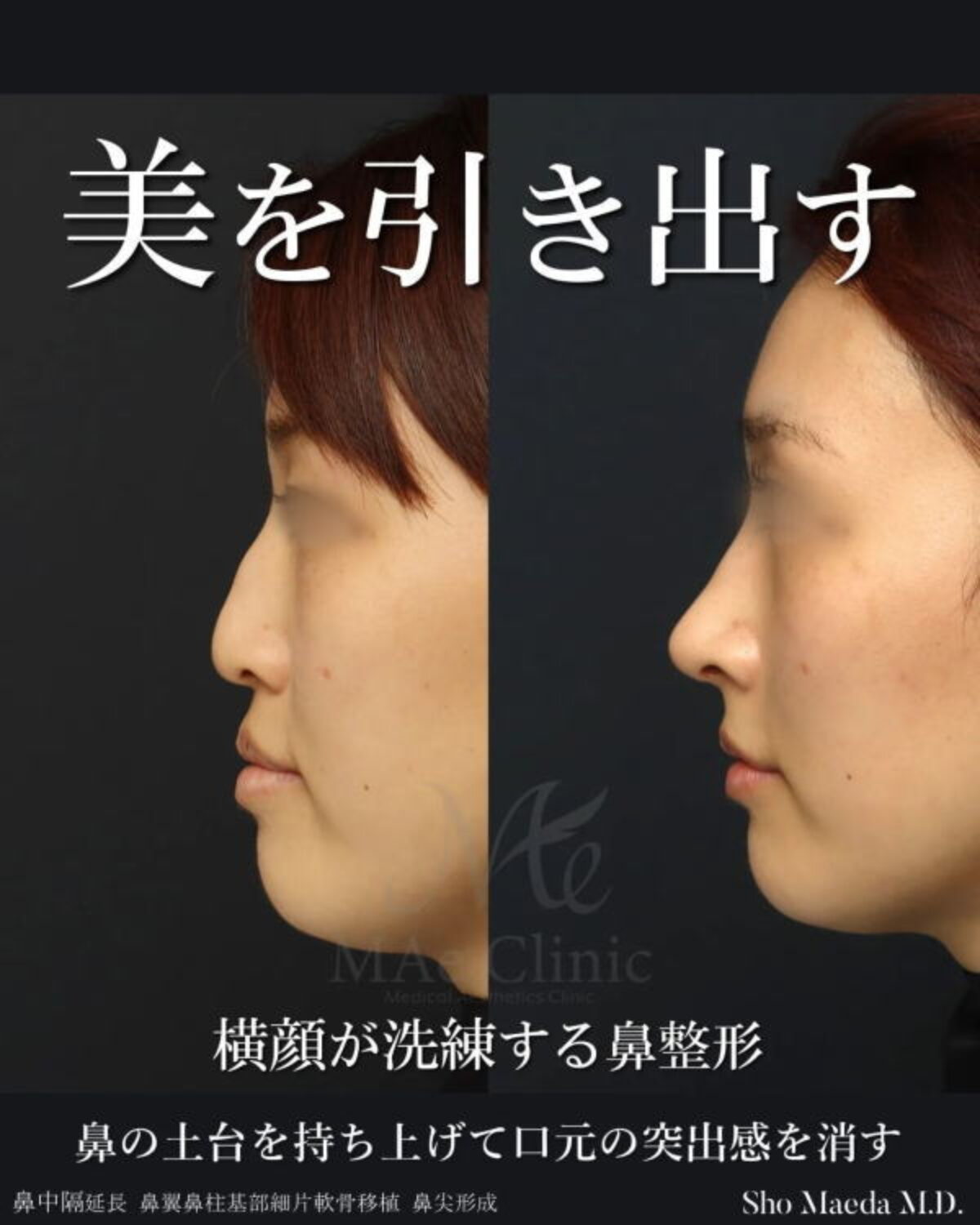 顔の土台を創る中顔面＆鼻整形【鼻中隔延長、鼻尖形成、梨状口縁