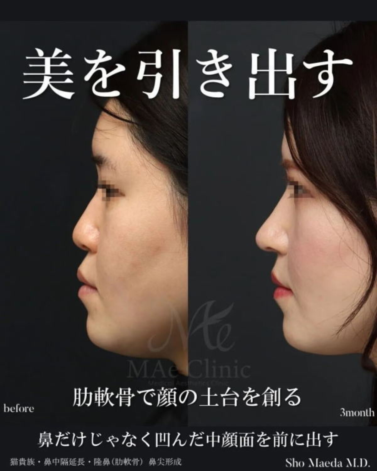 中顔面の陥没改善】骨切りなしで口元の突出感を解消｜猫貴族手術・鼻