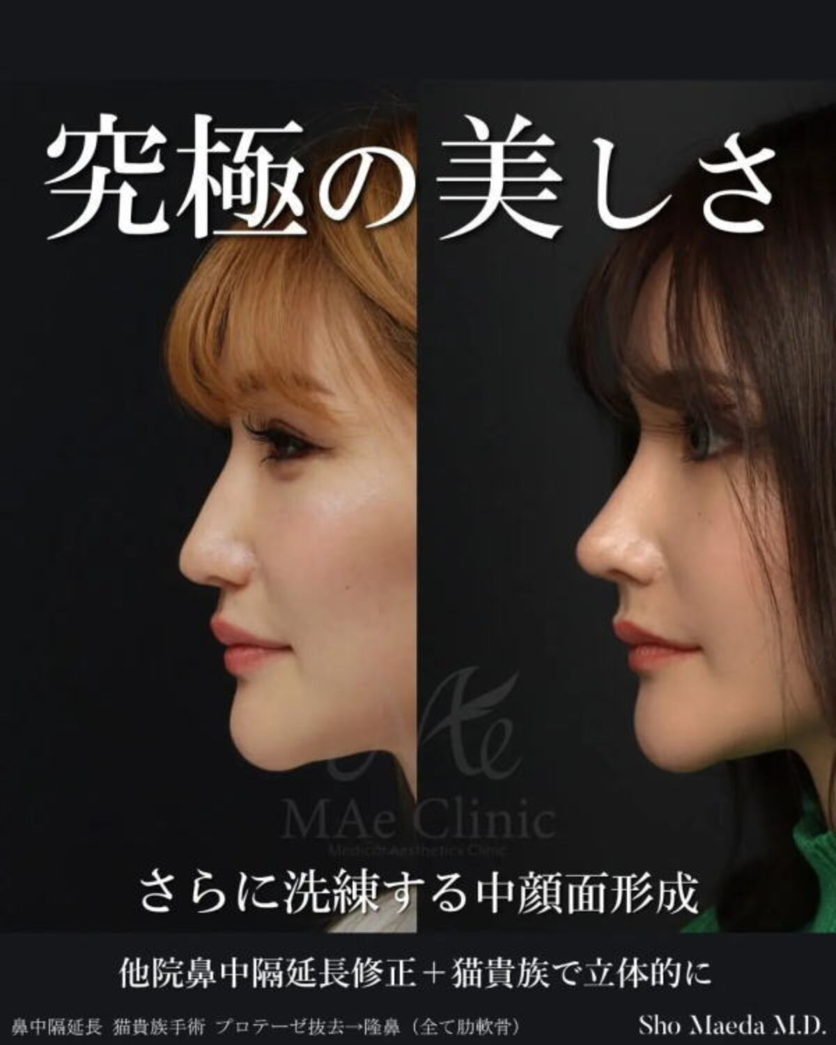 頬に埋まった鼻を立体的に整える｜猫貴族手術×鼻整形【肋軟骨×鼻中隔