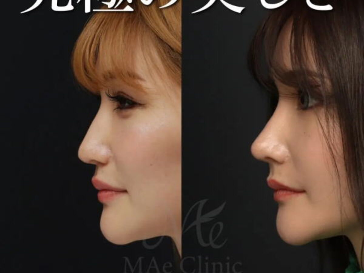 頬に埋まった鼻を立体的に整える｜猫貴族手術×鼻整形【肋軟骨×鼻中隔