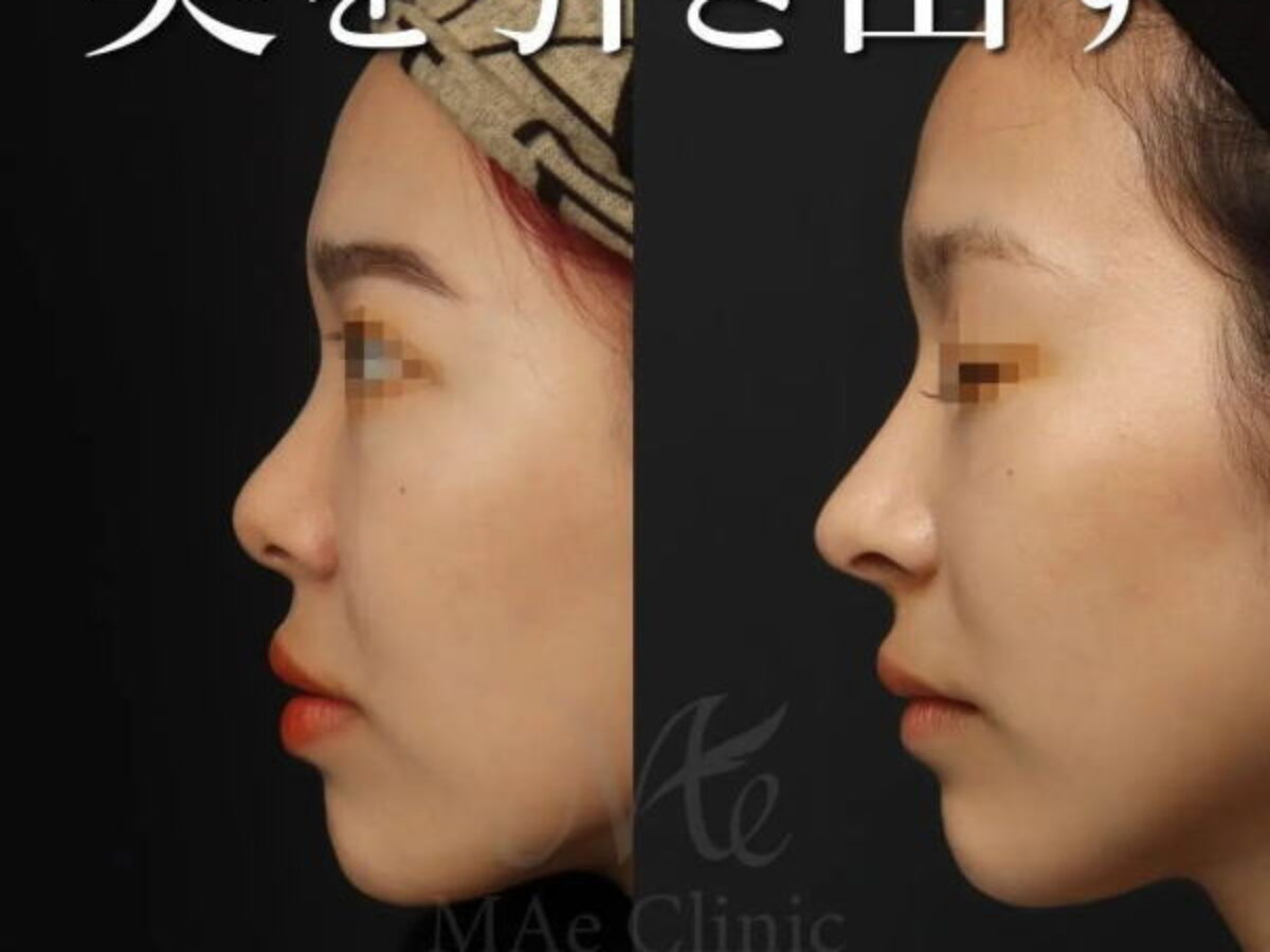 裁断済】外鼻形成術・鼻中隔矯正術 【公式通販】