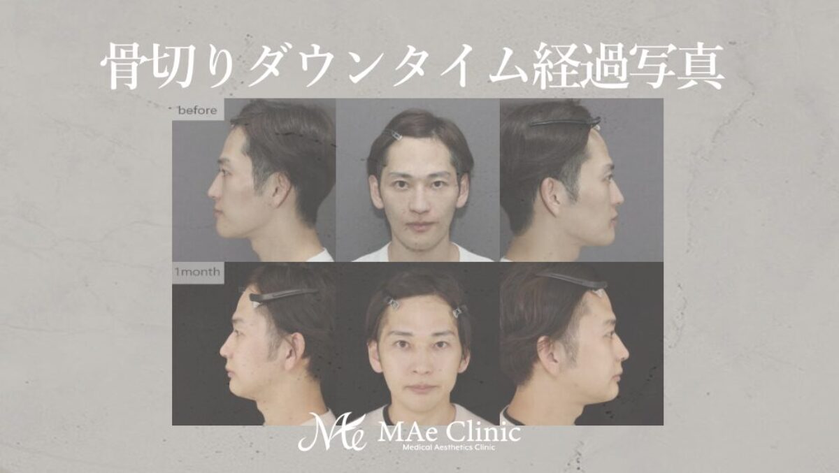 顎骨延長術の臨床応用 顎骨延長術の臨床応用 - クインテッセンス出版