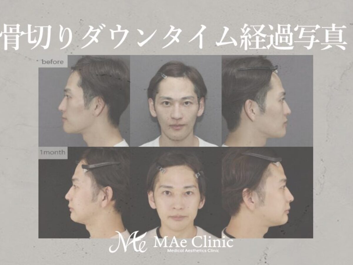 小顔整形】美容外科医が骨切り両顎、輪郭3点手術を受けました
