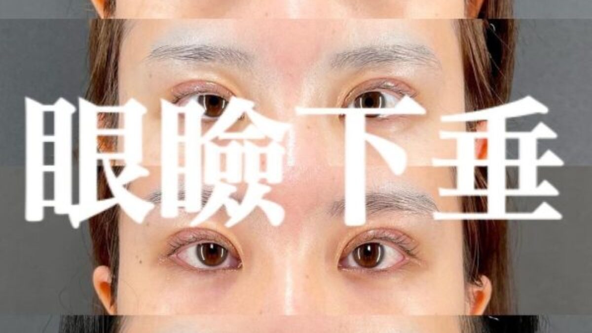 眼瞼下垂×術後3ヶ月 | MAe Clinic【マエクリ】