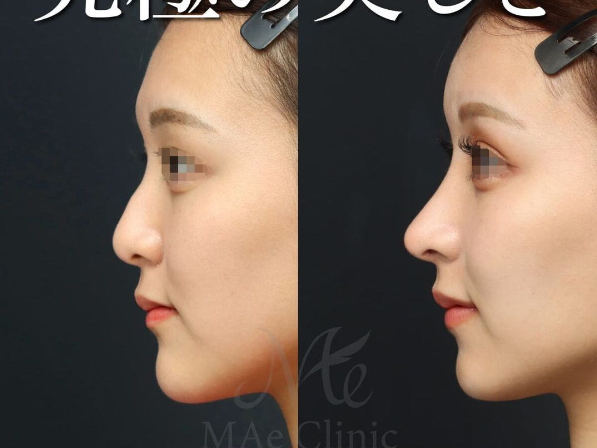 立体的に美しい顔とは【鼻中隔延長 猫貴族手術 ハンプ修正 額脂肪注入