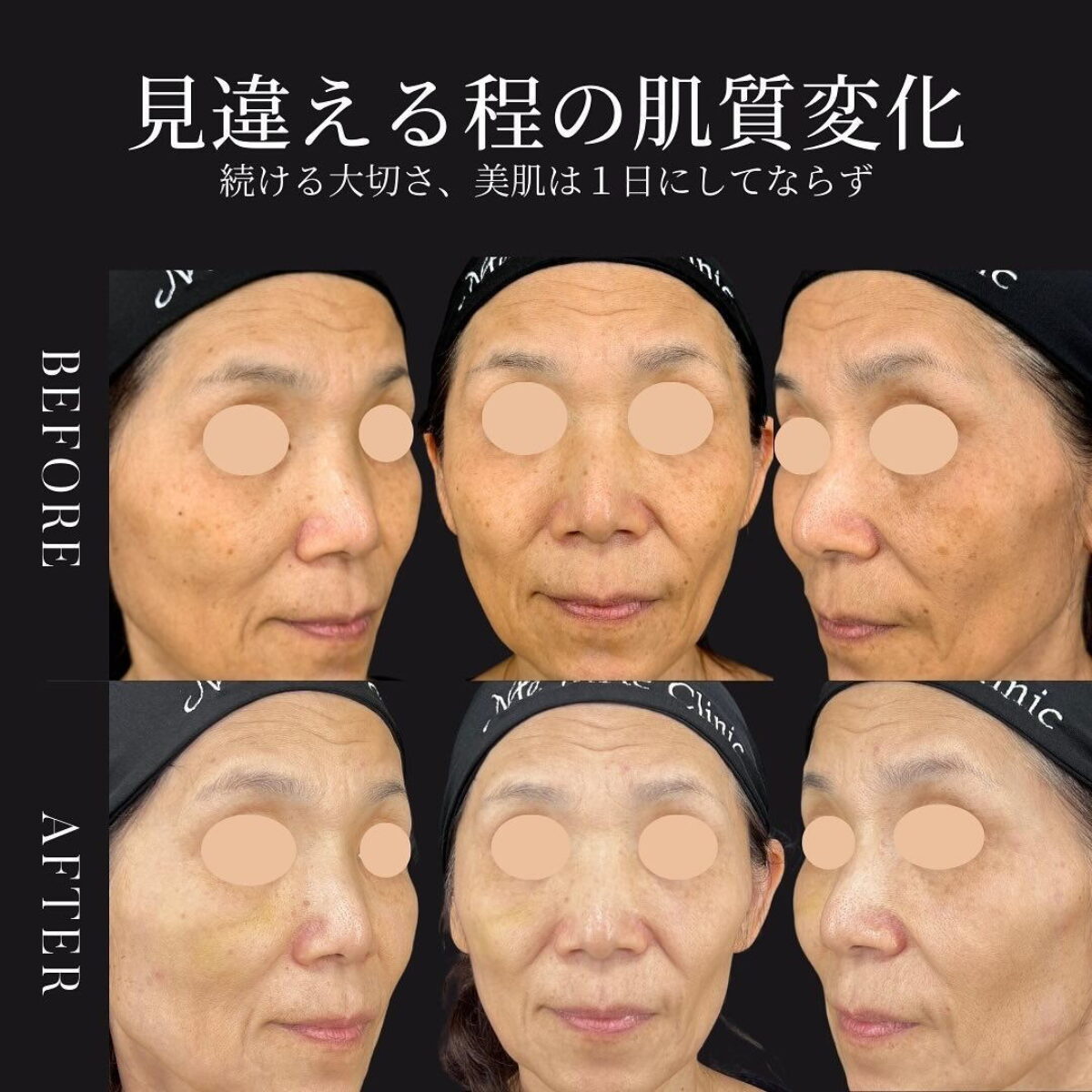 ルメッカ1回で効果ある？症例写真と医師解説で徹底検証【2025最新版