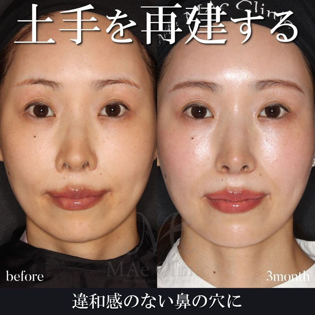 （裁断済み） 外鼻の再建 外鼻の再建 【裁断済み】 【公式通販】