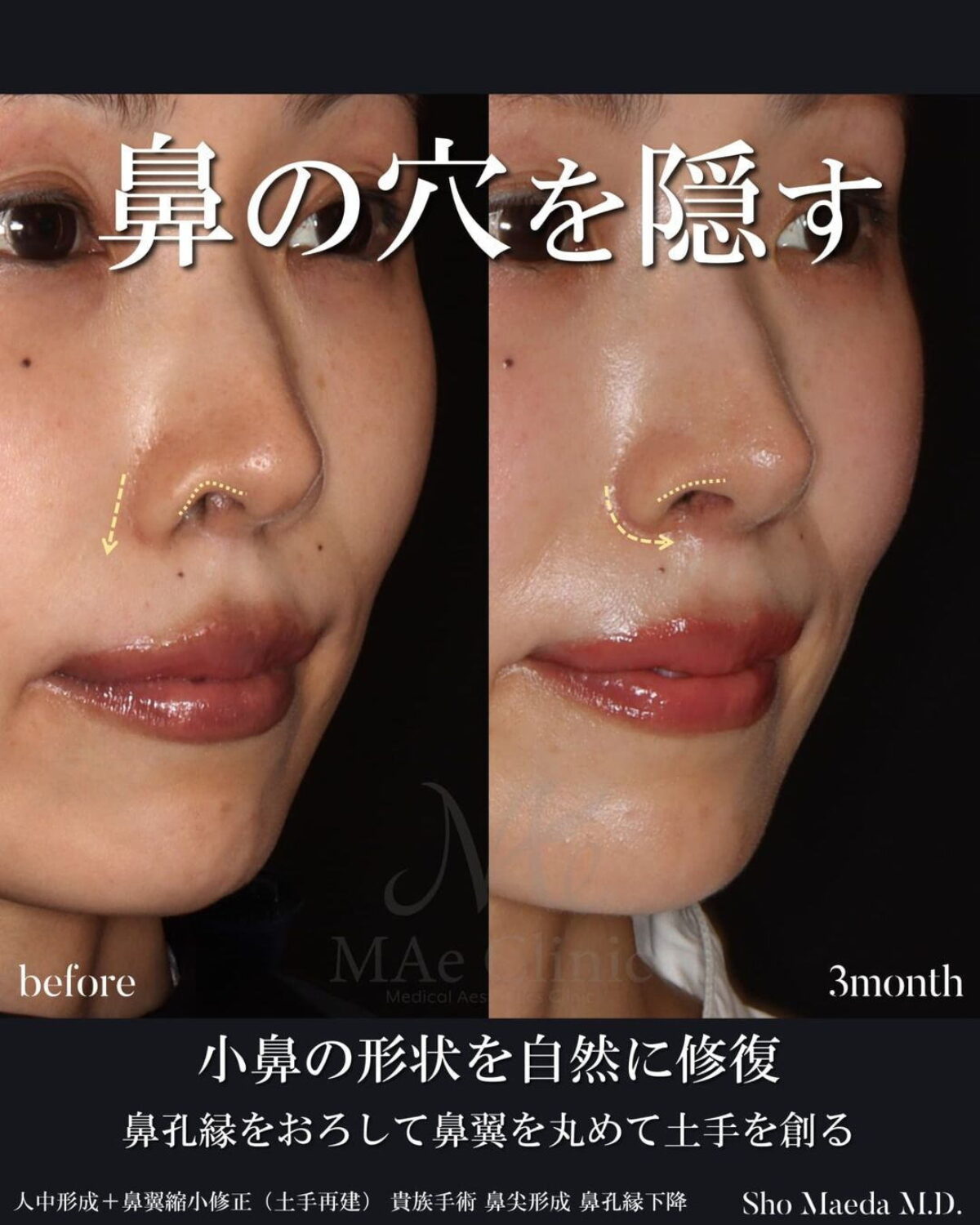 土手再建で鼻の穴の見え方も改善する】【鼻尖形成軟骨移植、鼻孔縁下降