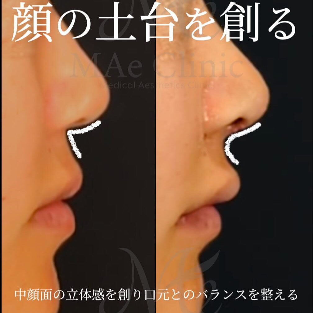 顔の土台を創り立体感を【鼻中隔延長 鼻尖形成 軟骨移植 猫貴族手術