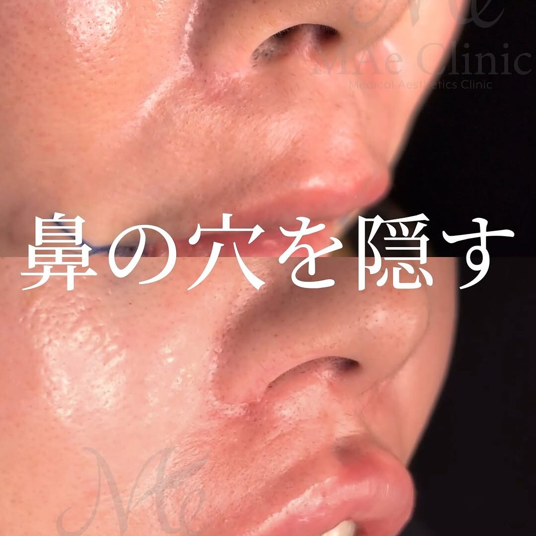 人中短縮の応用で土手再建【傷のつかない人中短縮、口角挙上術】術直後