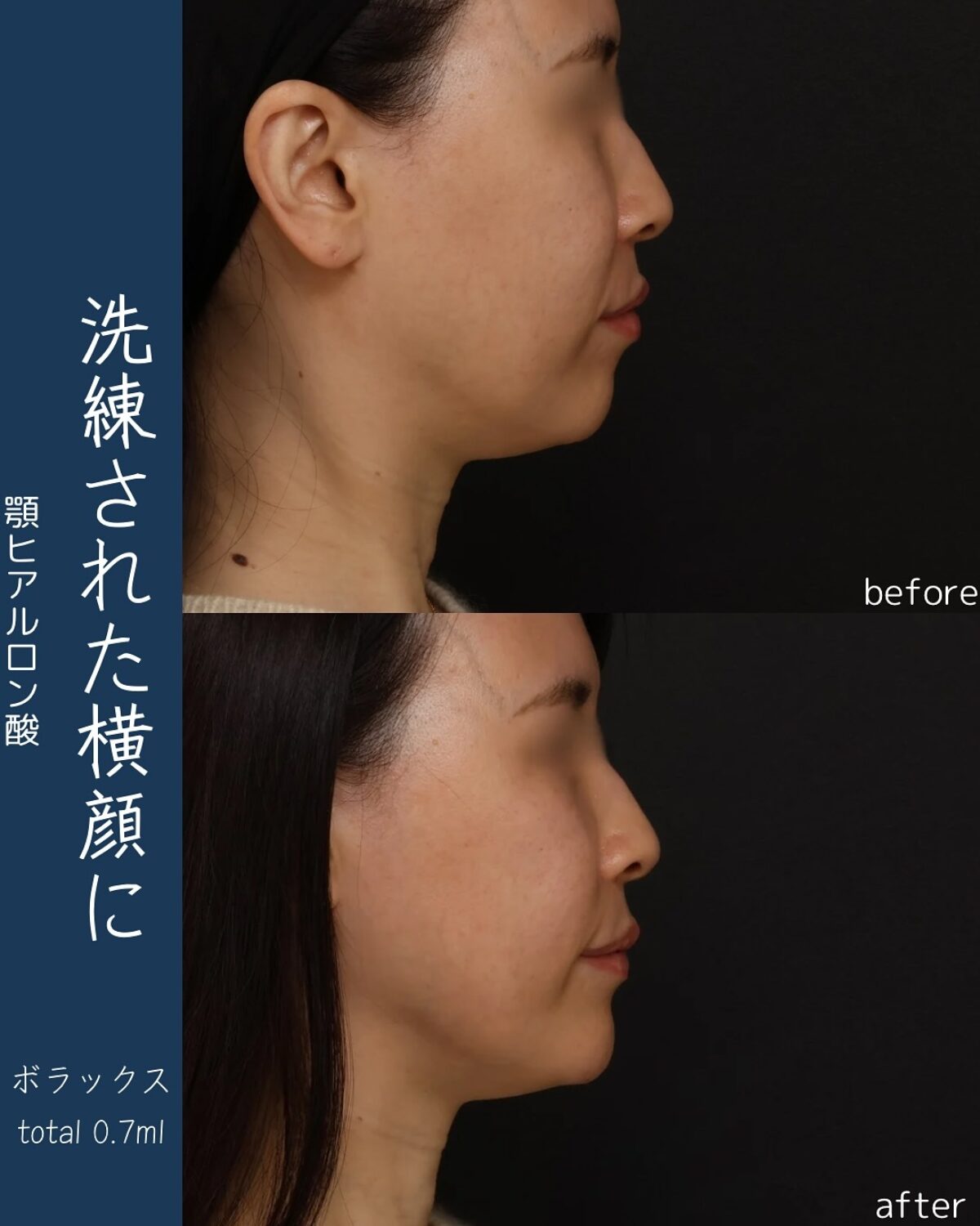 ヒアルロン酸 2024122326-1200x1500.jpg