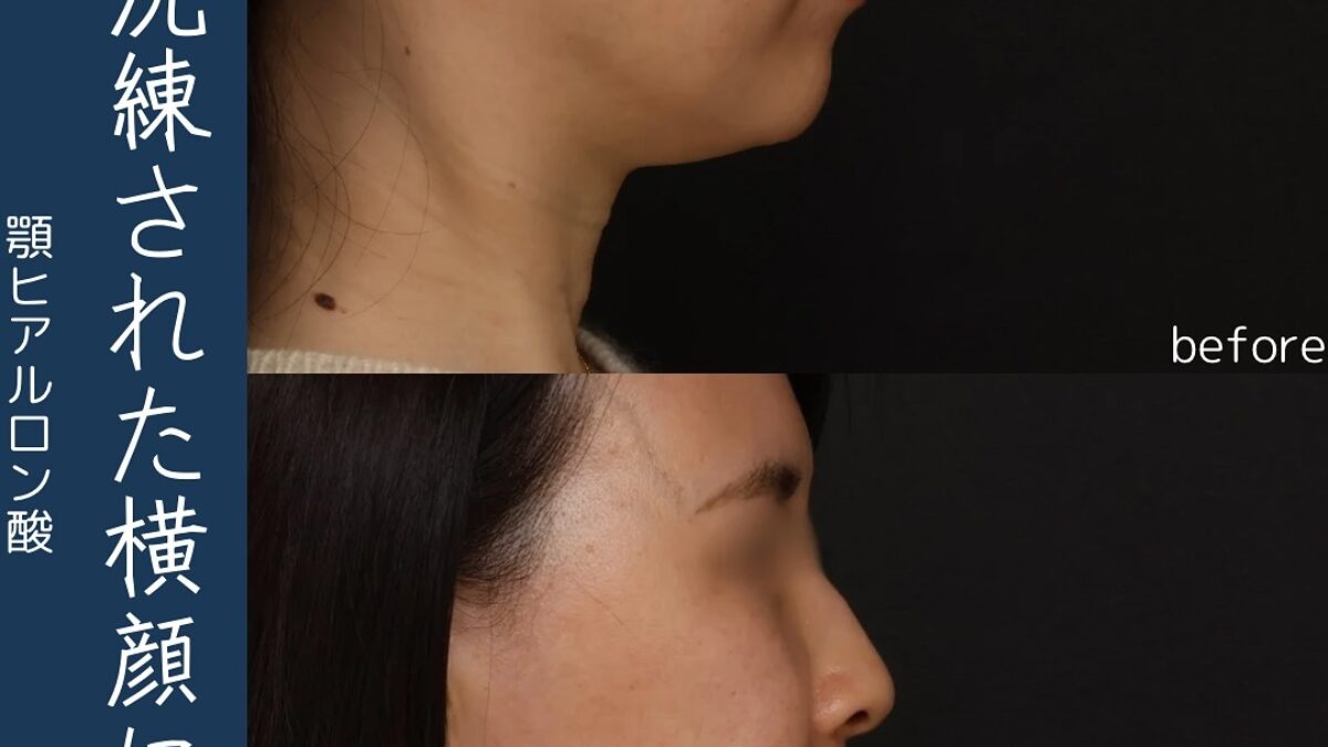 洗練された横顔【顎ヒアルロン酸注入ボラックス0.7ml】 | MAe Clinic