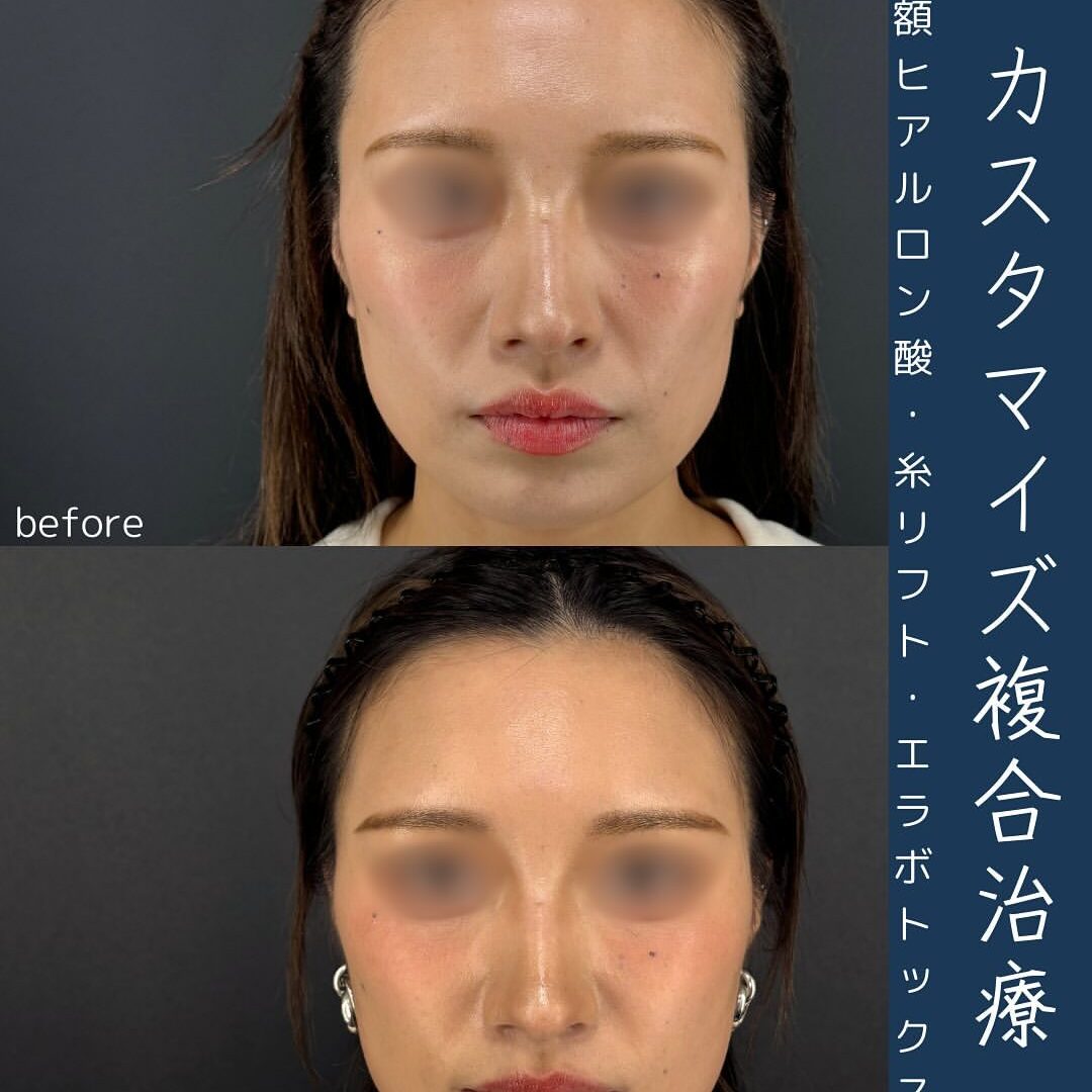 カスタマイズ複合治療で美人度アップ【額・こめかみヒアルロン酸、糸