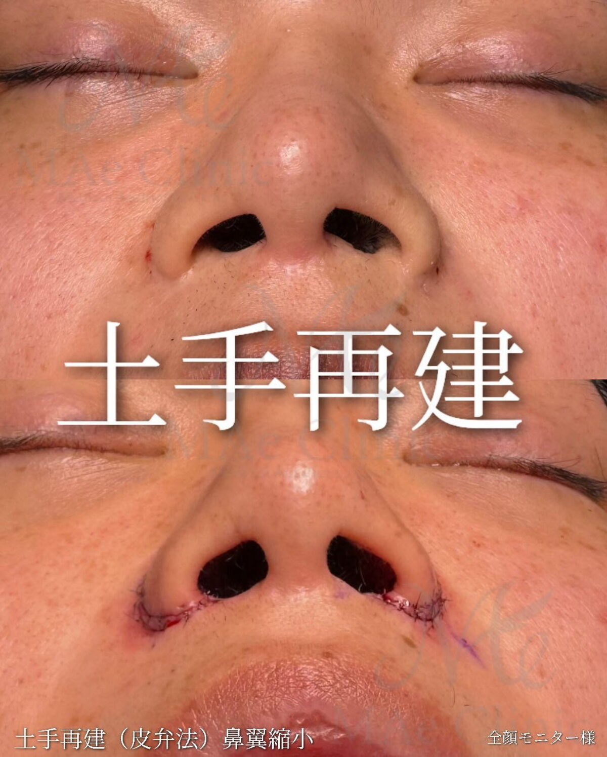 土手再建（皮弁法）鼻翼縮小×術直後 | MAe Clinic【マエクリ】