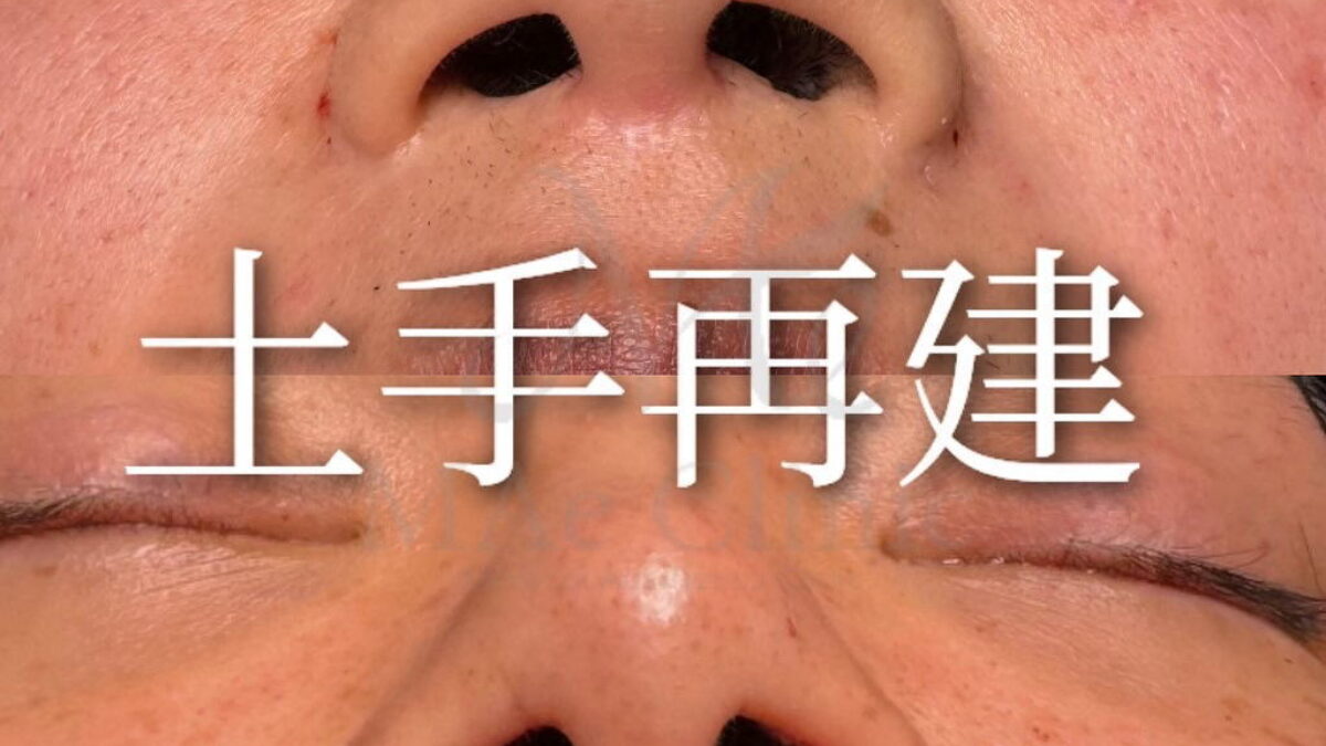 土手再建（皮弁法）鼻翼縮小×術直後 | MAe Clinic【マエクリ】