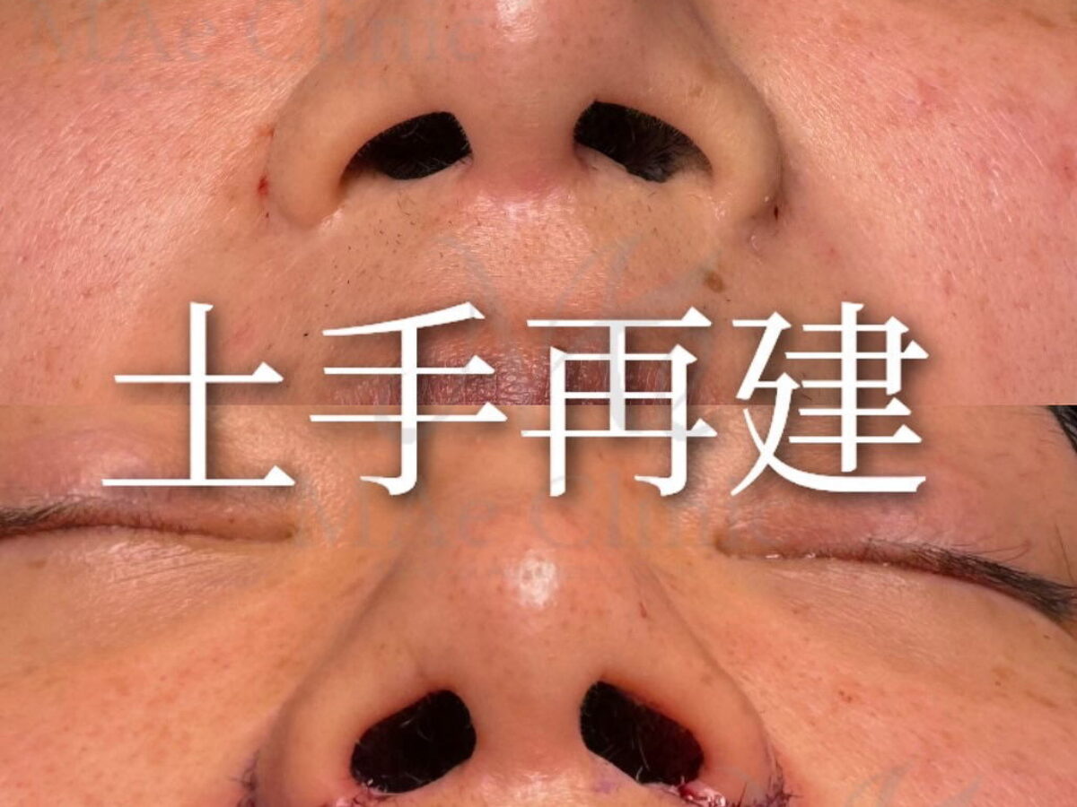 （裁断済み） 外鼻の再建 外鼻の再建 | 小林誠一郎 |本 | 通販 | Amazon