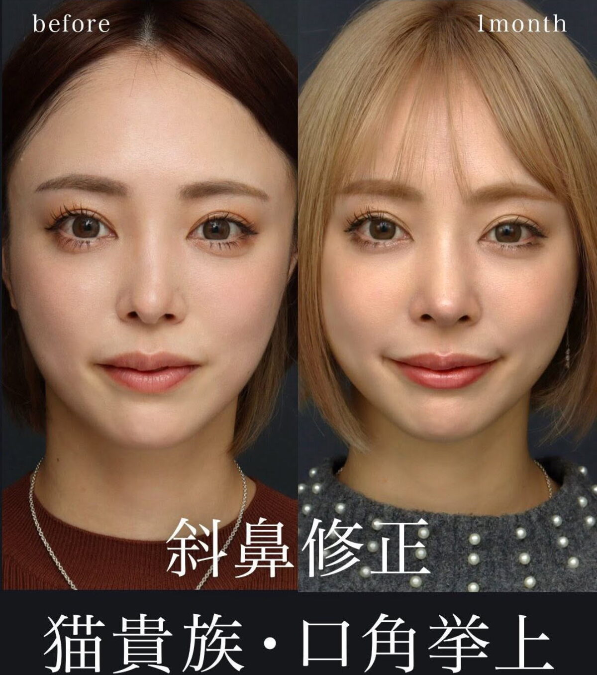 サキ吉さんの斜鼻治療【斜鼻修正、鼻中隔延長、鼻尖形成、梨状口
