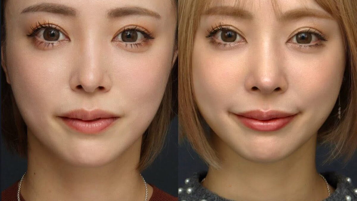 【裁断済、書き込みなし】外鼻形成術・鼻中隔矯正術 裁断済、書き込みなし】外鼻形成術・鼻中隔矯正術 外鼻形成術