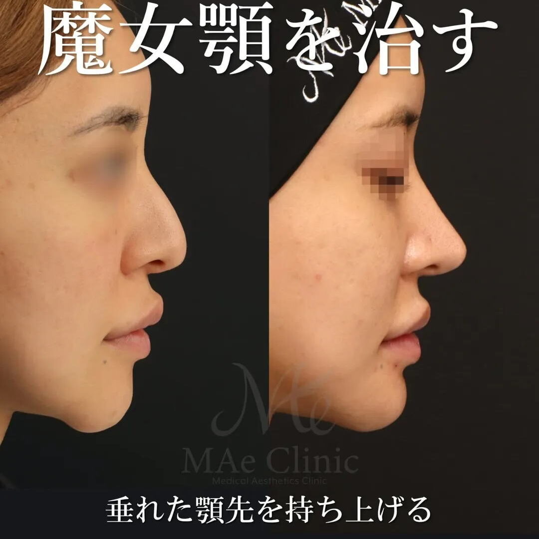 魔女顎治療【鼻中隔延長・猫貴族手術・鼻尖形成・隆鼻術 (全て肋軟骨