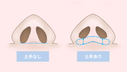 鼻の土手　ありなし