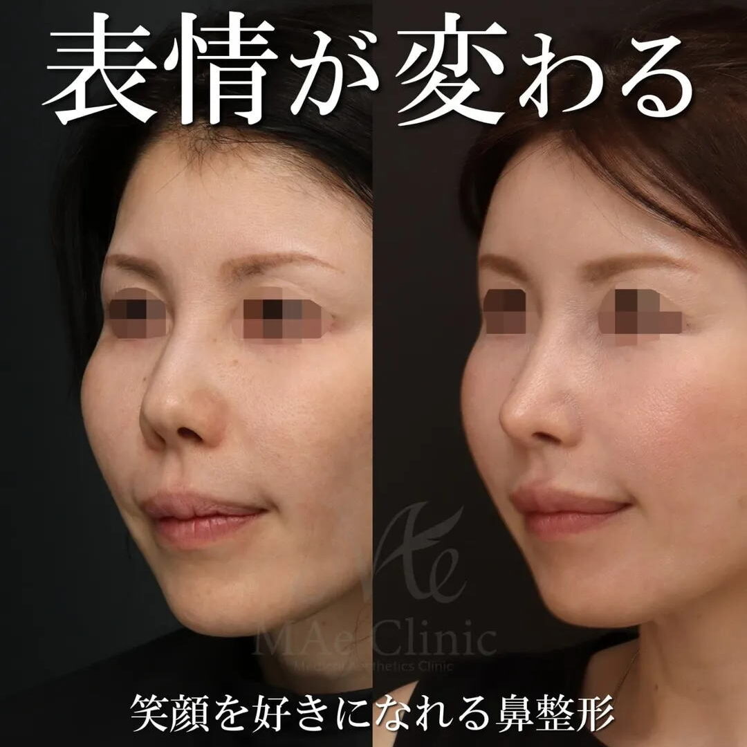 美しい表情に』【鼻中隔延長、猫貴族手術、鼻尖形成、隆鼻術