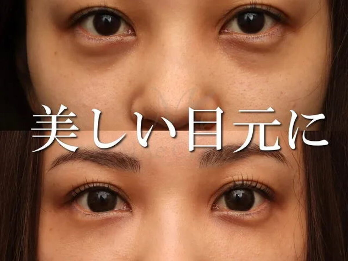 クマも綺麗に治します』【クマ治療（下眼瞼脂肪移動、脂肪注入）】術後