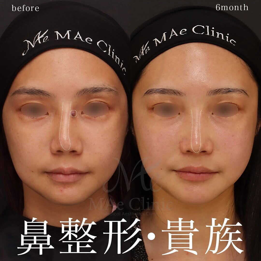 鼻形成術 2025041202-1080x1080.jpg