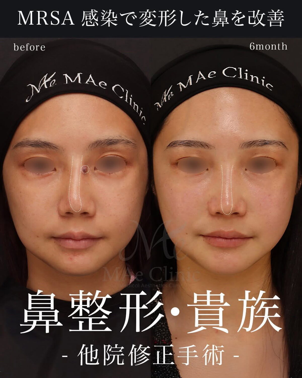 鼻形成術 2025041202-1200x1500.jpg
