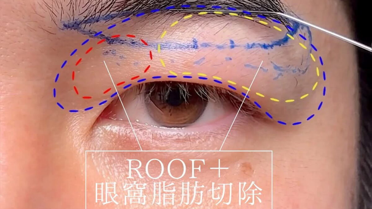 眉下リフトは皮膚を切るだけじゃない」重たいまぶたを根本から治す治療
