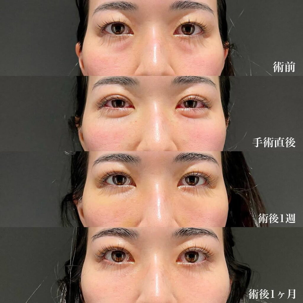 裏ハムラ 裏留め 埋没 二重 症例