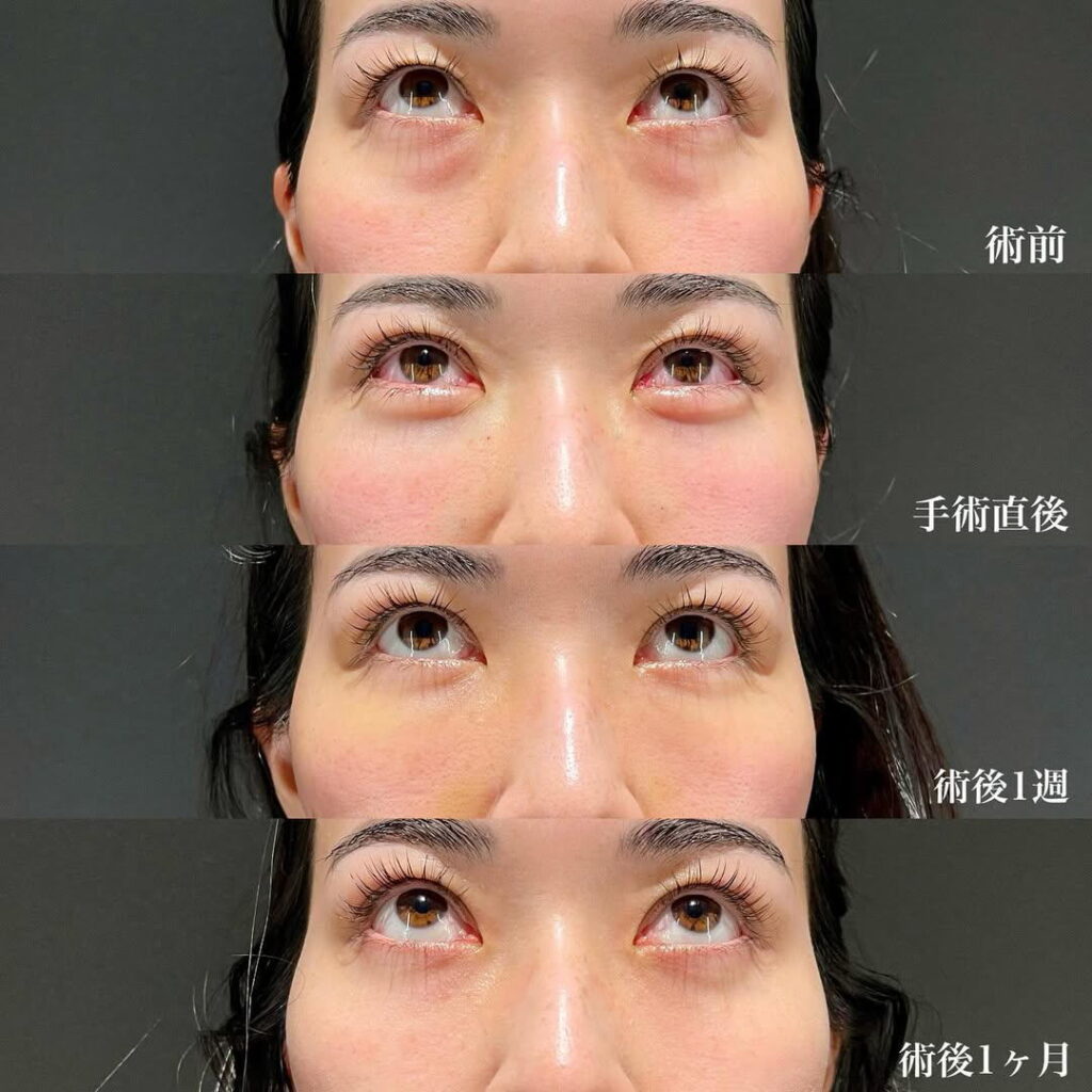 裏ハムラ 裏留め 埋没 二重 症例