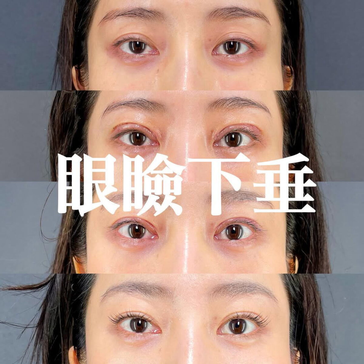 症例解説】眼瞼下垂をナチュラルに改善した6ヶ月の経過 | MAe Clinic