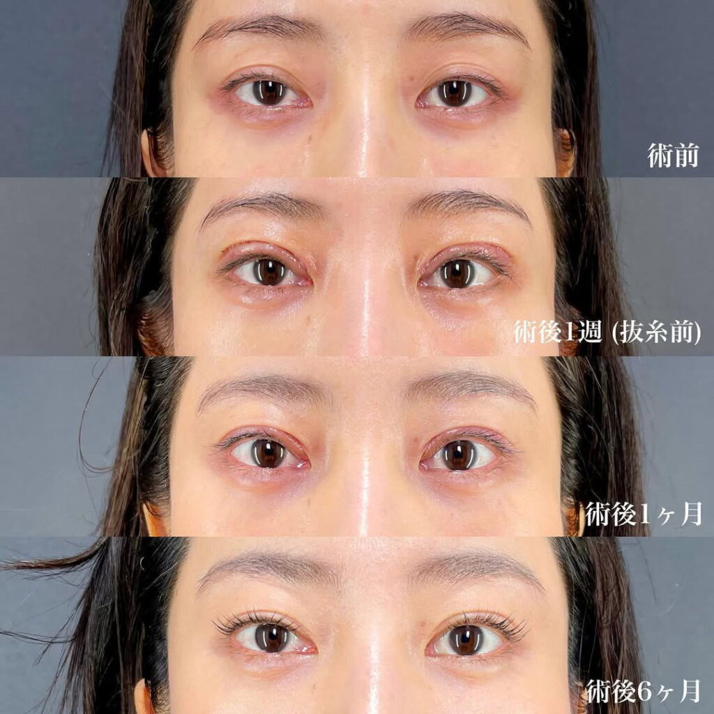 眼瞼下垂 症例
