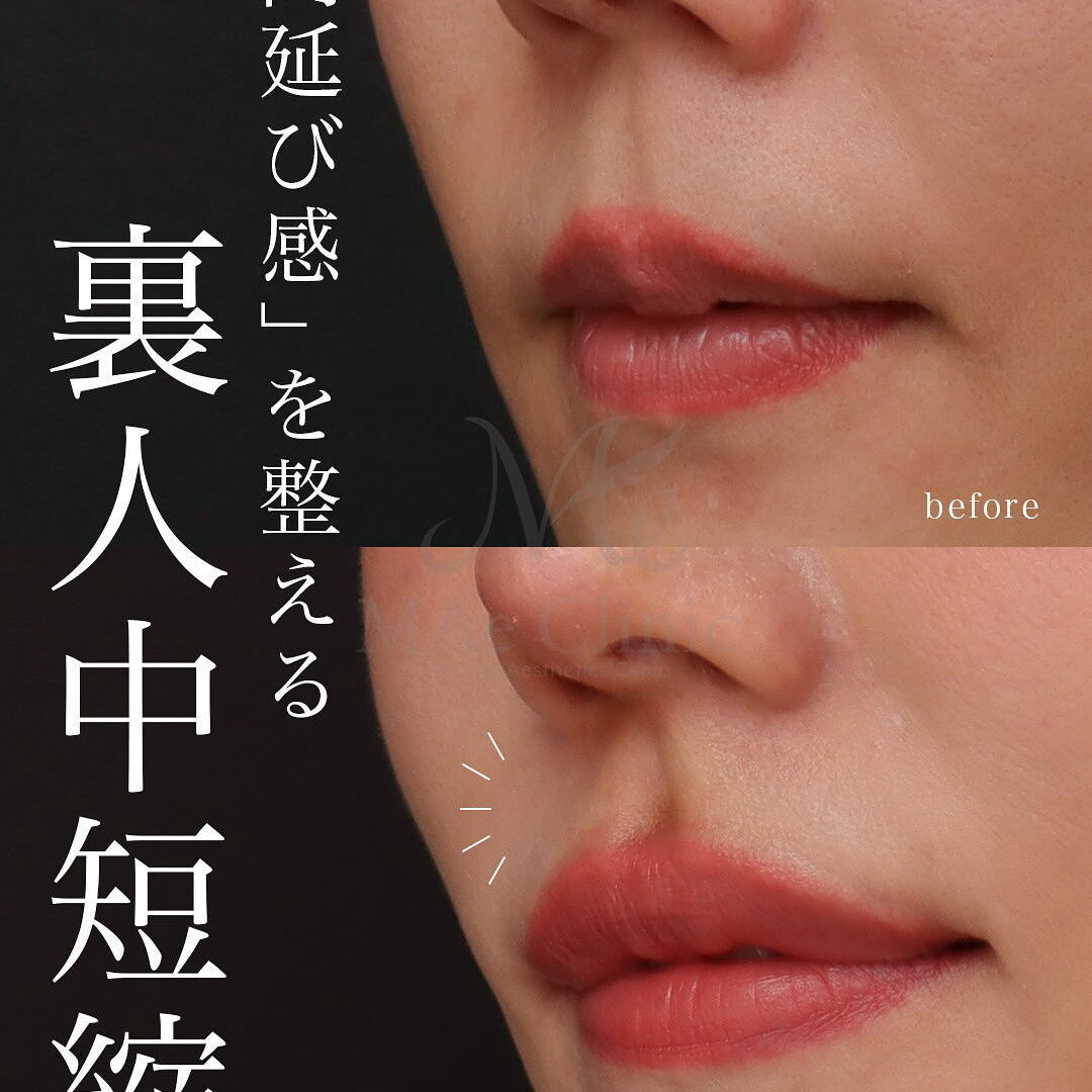 birbira karcoビルビラ2️⃣ 前髪短め、口空洞モデル 症例紹介】裏人中短縮×人中窩形成でCカールと立体感のある口元に｜術後