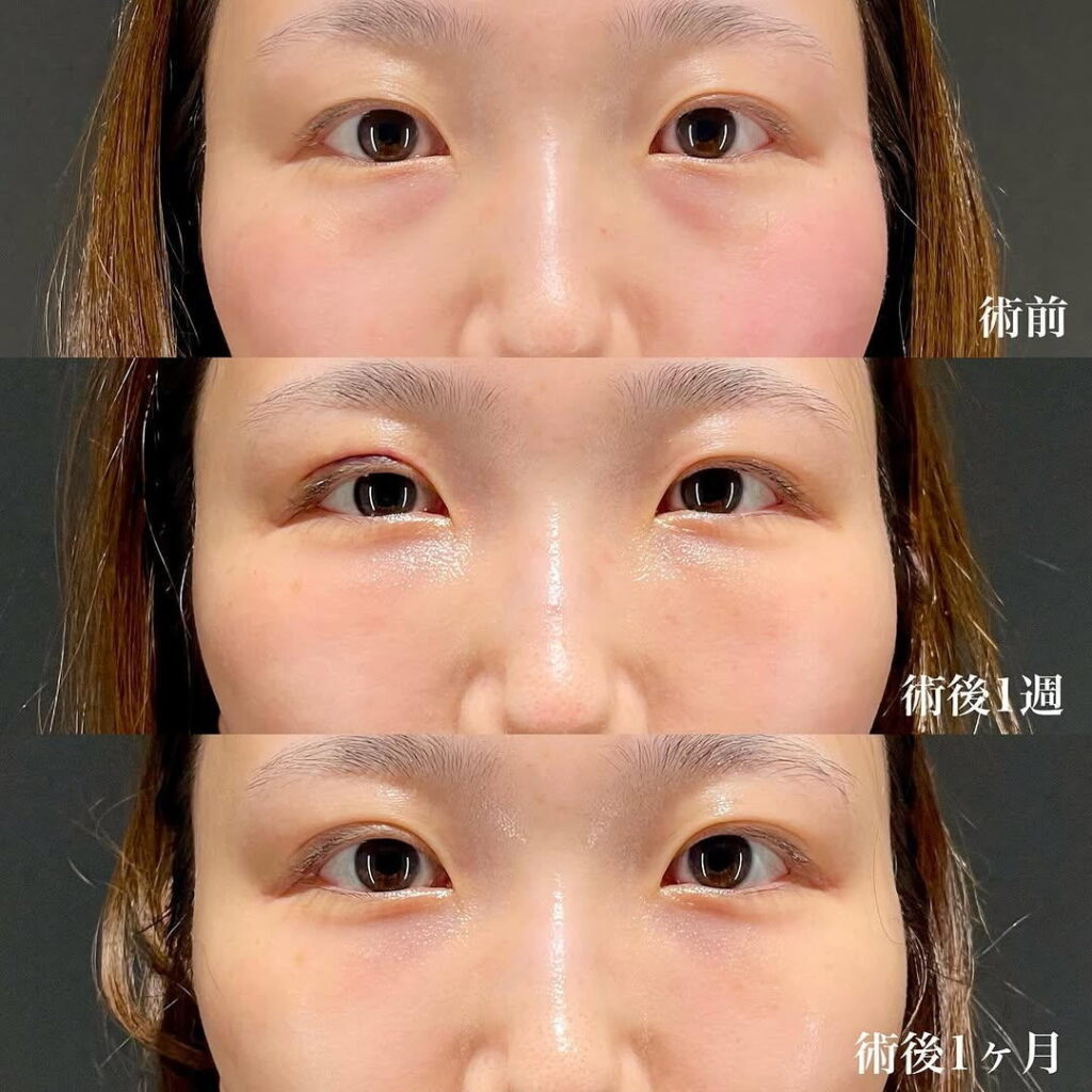 裏ハムラ 症例