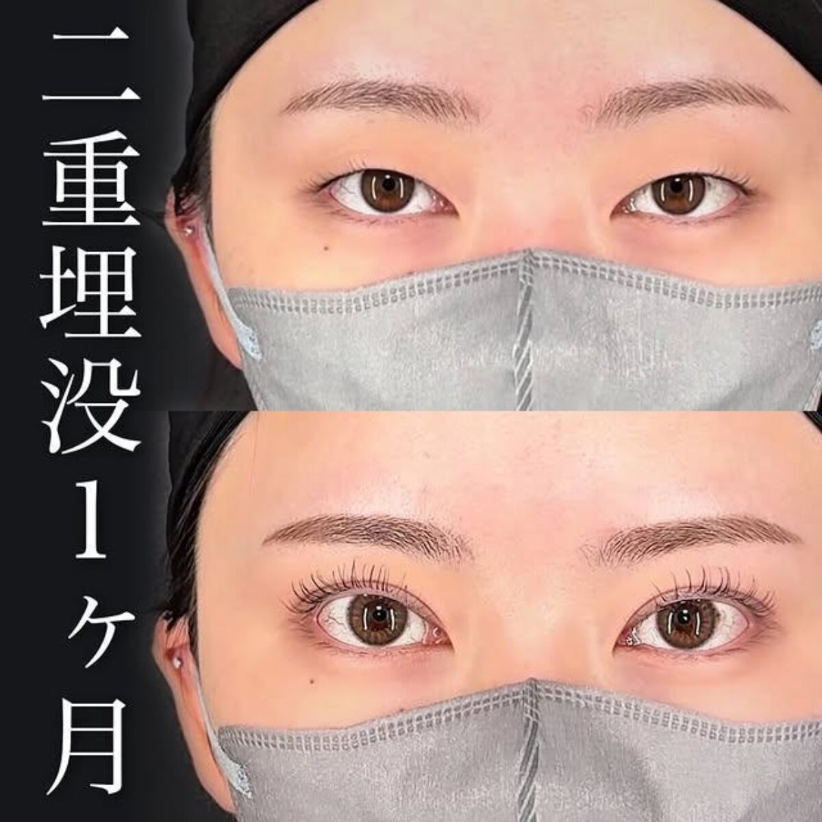 まゆげ まつ毛がしっかり見える自然な二重に｜皮膚の薄いまぶたを活かした