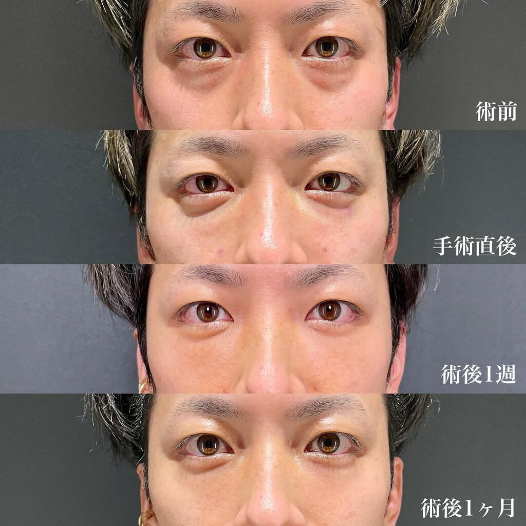 裏ハムラ症例