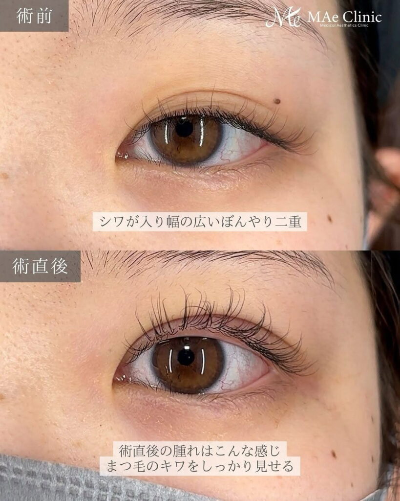 埋没二重 症例