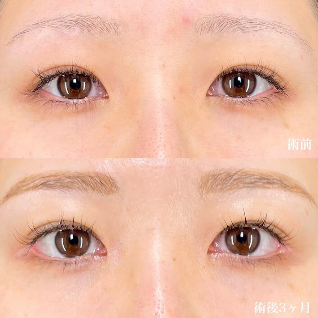 白目拡大術 裏ハムラ 目頭切開 症例