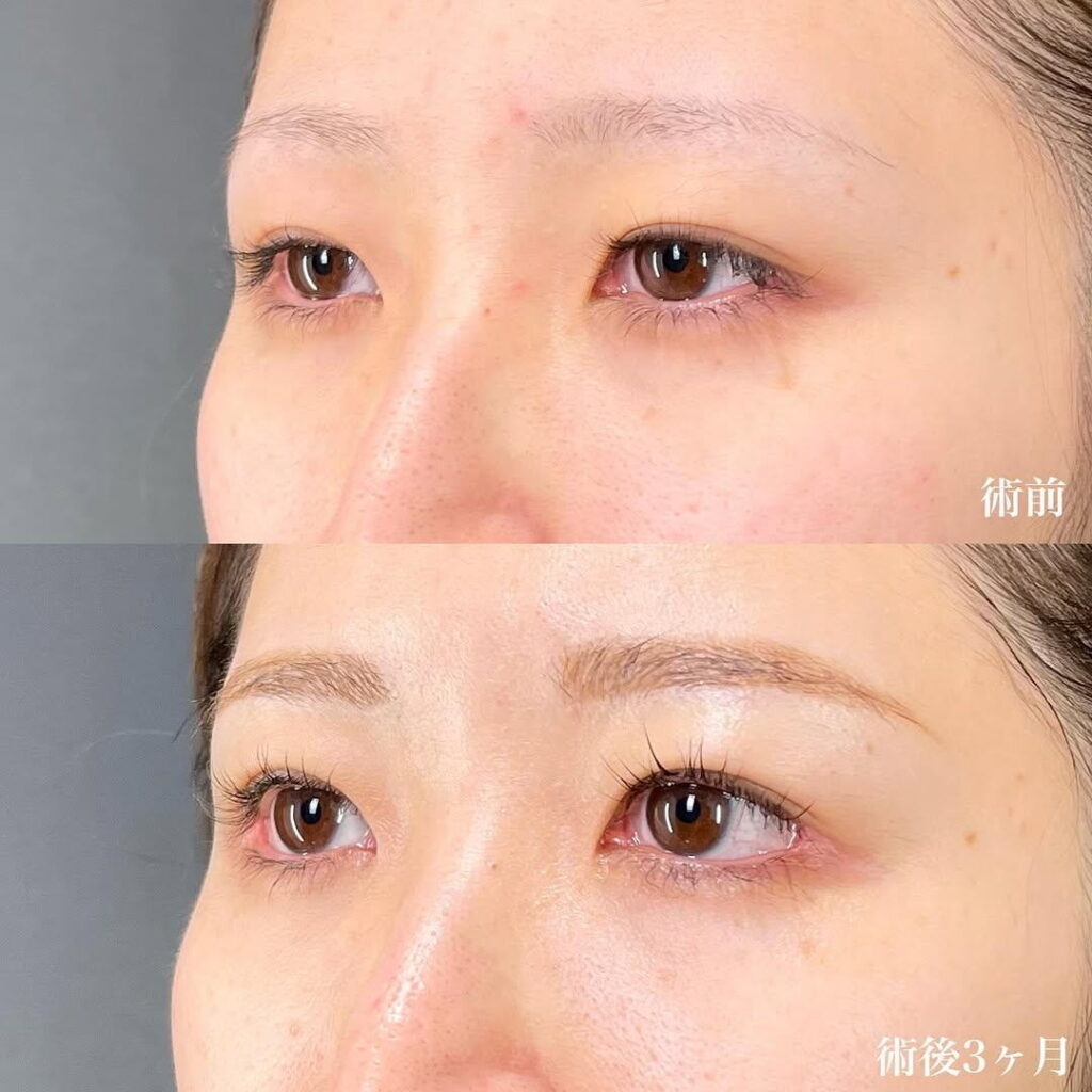 白目拡大術 裏ハムラ 目頭切開 症例