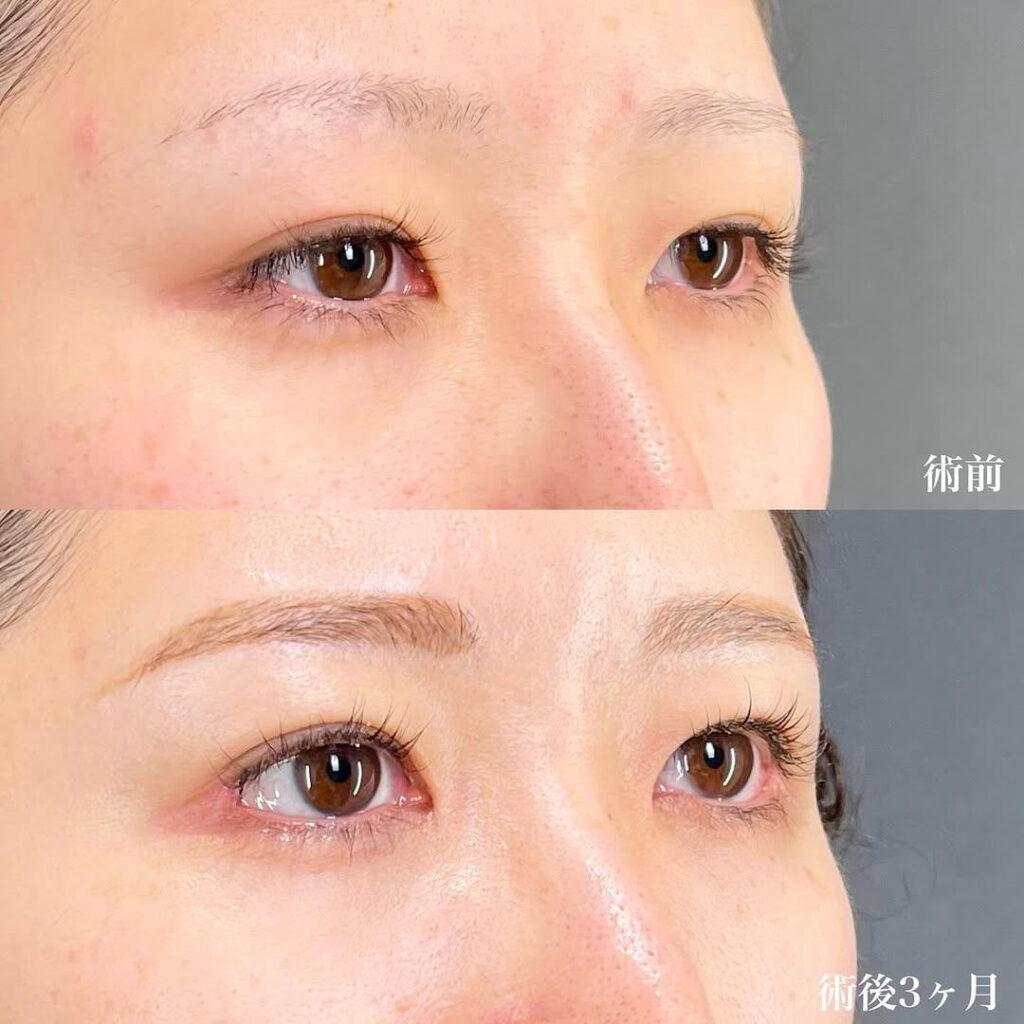 白目拡大術 裏ハムラ 目頭切開 症例